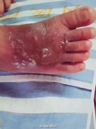 2岁男童双脚被烫伤 园方:老师试水温时失误
