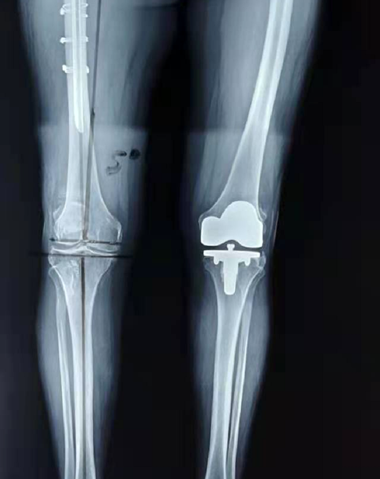黔南州中医院人工膝关节置换进入人工智能时代